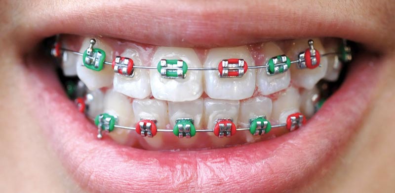 טיפולי יישור שיניים לילדים